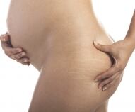 Cellulite in gravidanza