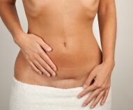 Cicatrice del taglio cesareo