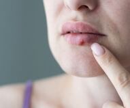 herpes labiale in gravidanza