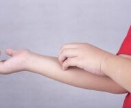 Impetigine nei bambini