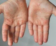 Malattia mani piedi bocca