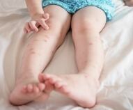 perche le zanzare pungono