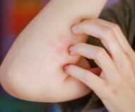 quinta malattia nei bambini quando compare l esantema la malattia e finita