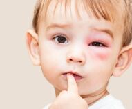 Allergie alle punture di insetti