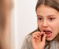 Traumi ai denti nei bambini