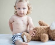 Varicella nei bambini