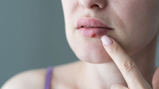 herpes labiale in gravidanza