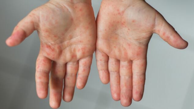 Malattia mani piedi bocca nei bambini e in gravidanza: sintomi iniziali, come inizia, come si cura, quanto tempo è contagiosa malattia mani piedi bocca