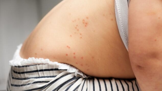 Scarlattina nei bambini: incubazione, contagio, sintomi e terapia. Come capire se un bambino ha la scarlattina e cosa fare scarlattina nei bambini sintomi e cura