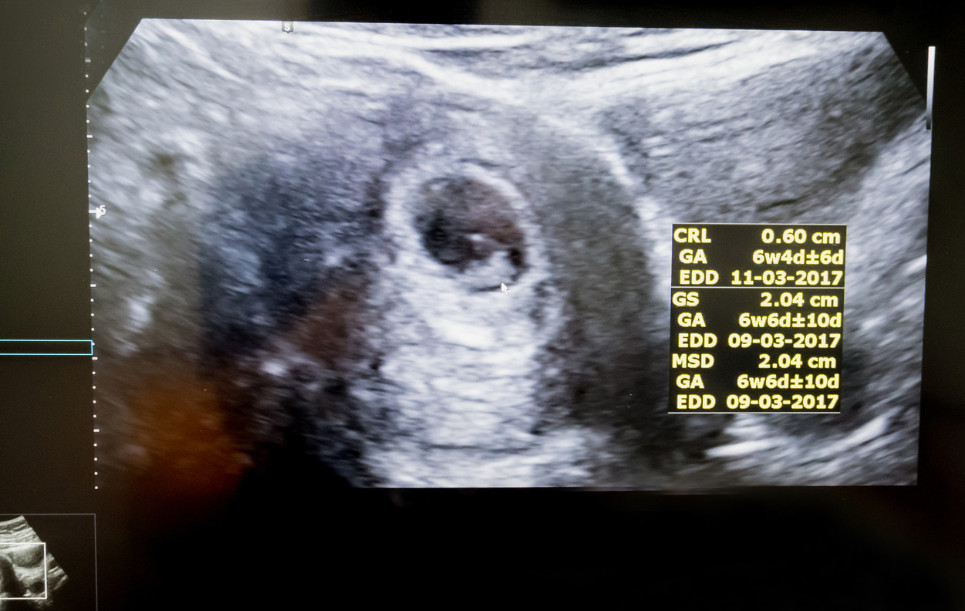 ecografia primo mese gravidanza